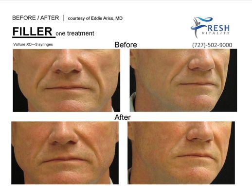 Cosmetic Dermal Filler, Juvederm Vollure XC 3 Syringes 1.0 ml each, Mid Face & Nasolabial Folds