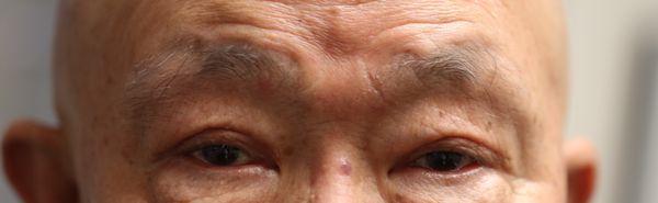 After- Blepharoplasty