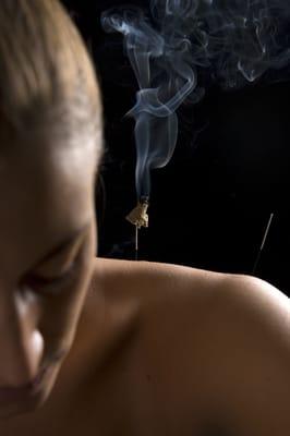 Moxibustion is a technique where Chinese mugwort is used to apply heat in certain acupuncture points.