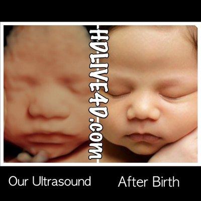 our HDLIVE4D technolgy vs the babys Birth image.  WOW!