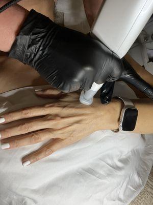 Jet Plasma Hand Treatment