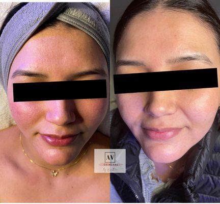 Before and Immediately After Sensitive Skin Facial