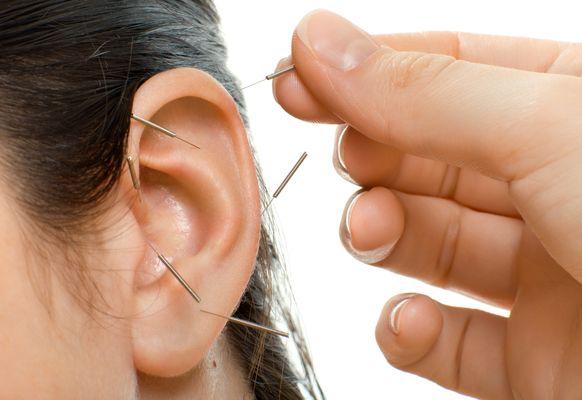 Auricular acupuncture