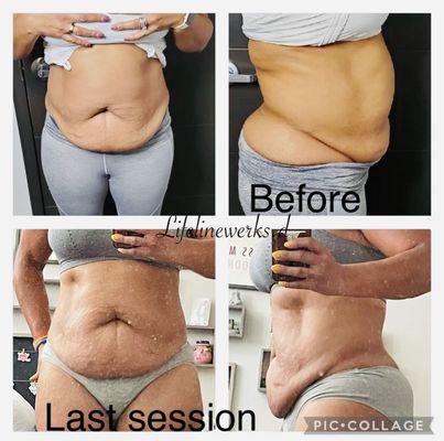 Service performed: Laser lipo, Cavitation, Skin Tightening, and Vacuum Therapy for 30 days.