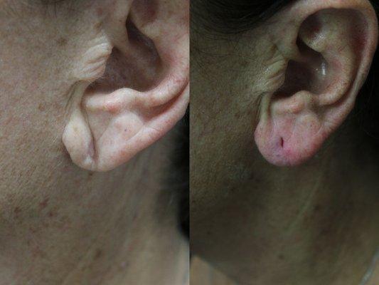 Before and after of non-surgical lobe rejuvenation with fillers.