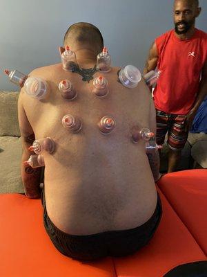 Cupping