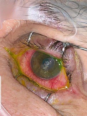 Surgery on the Cornea, right eye