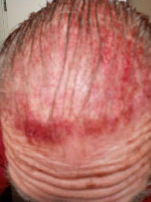 Micro needling PRP plasma again. Over $14,000 in medical treatment attempting to repair chemically burnt scalp from incompetent hair dresser