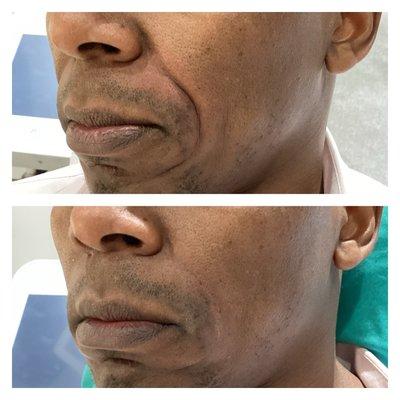 One syringe Juvederm Voluma nasolabial fold