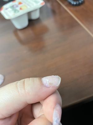 Fungus on my nail