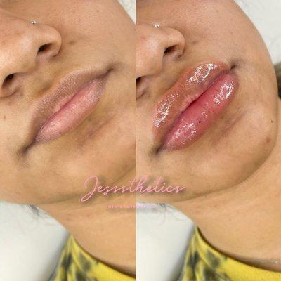 Full plump lips filler achieved with the Hyaluron pen