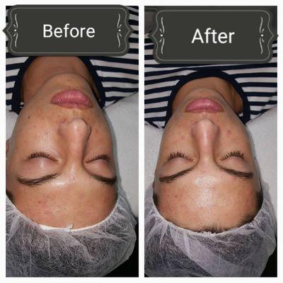 Detox facial