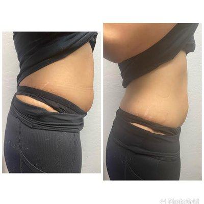 1 Laser-Lipo session lost 1 inch