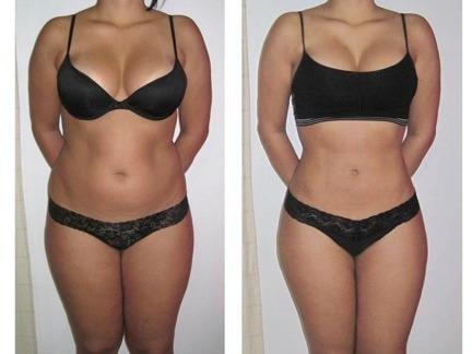 Body Contouring