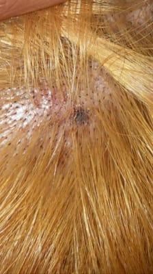 This is my scalp after a hairdresser at Gloria's used a chemical and burned me.