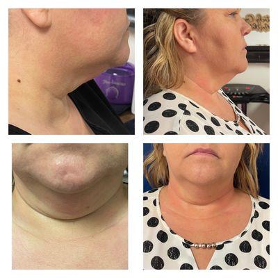 CryoSlimming double chin 6 sessions