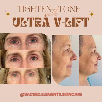 Ultra V-Lift Facial Treatment transformations!