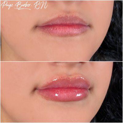 Before and after lip augmentation by Paige Barber, RN