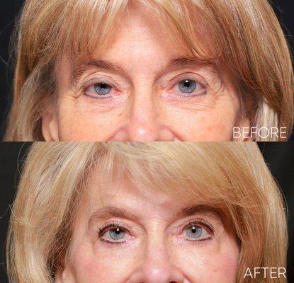 Ptosis Repair and Brow Lift