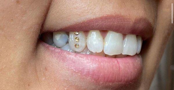 Tooth gems