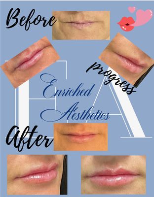 Lip filler before and after