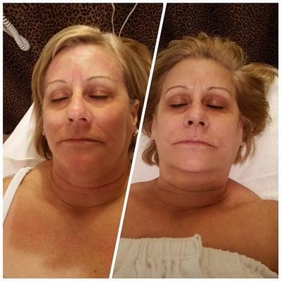 Facial Microcurrent: Before/After