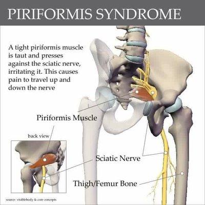 Sciatica Treatment