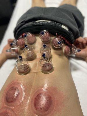 Lower back cupping. Helps release pressure off the SIATIC nerve .