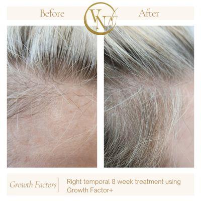 Beginning stages of female pattern hair loss  8 week treatment with Growth Factors+