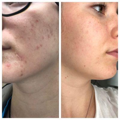 Before and after of acne treatment.