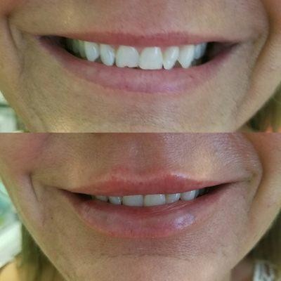 Lip filler to enhance smile Botox injections for smile augmentation