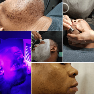 Ingrown Hair Removal Specialist