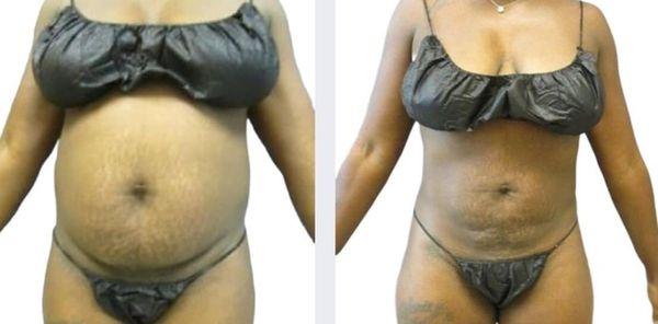 Stomach Lipo cavitation