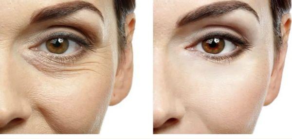 Reduce the appearance of lines and wrinkles in just one treatment.