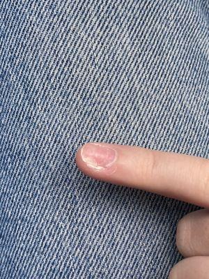 Nail fungus.