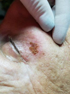 Keratosis directly after removal