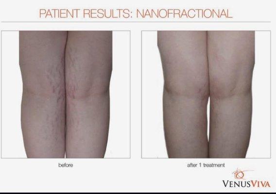 Stretch mark reduction with the Venus Viva Nanofractional Treatment