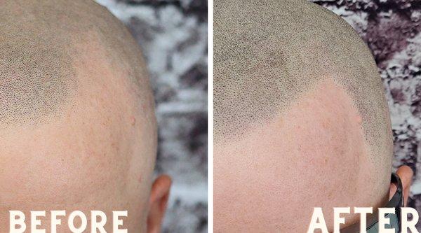 Scalp Micropigmentation By Alex Corona