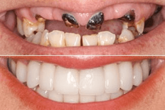 Before and After at NÜVA Smile | Bergenfield, NJ