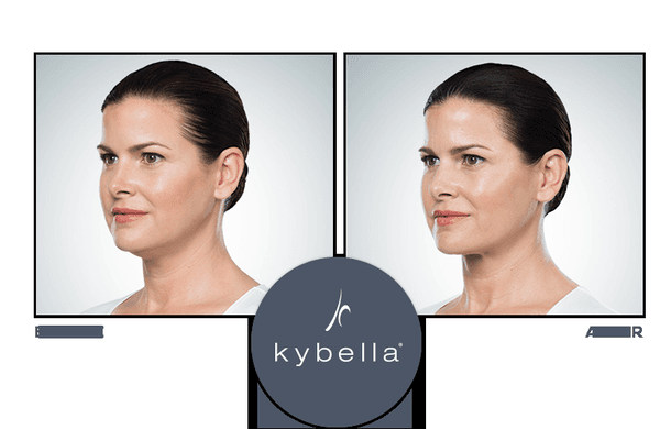 We can help you get rid of an unwanted double chin with Kybella treatments.