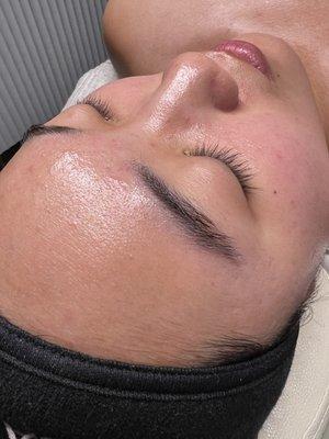 aqua peel/hydra facial