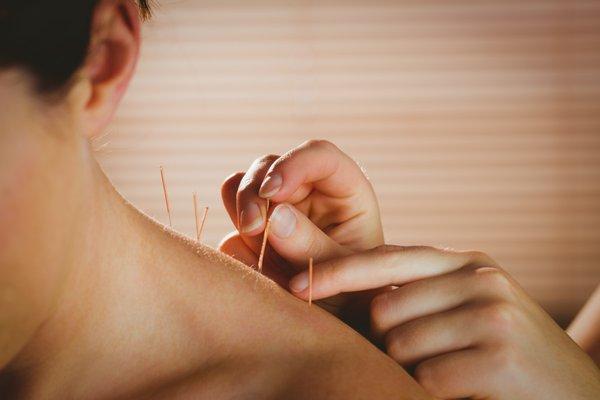 Acupuncture treatments can be done without having to get naked!