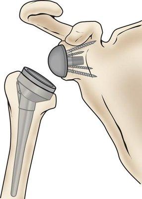 Reverse Total Shoulder Replacement