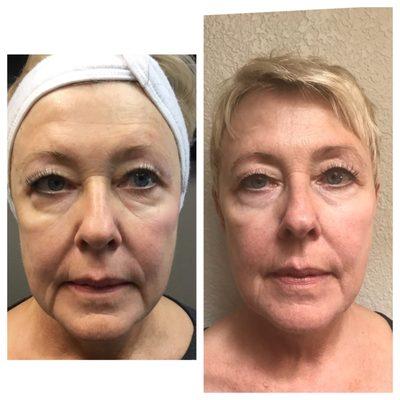 Jowel, Nasolabial, Upper lid and Eye lift, crows feet and glabella- 1 treatment