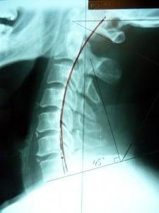 Case NC after two months of care. His alignment is now correct.  Note the vertebra are now on the red arc.