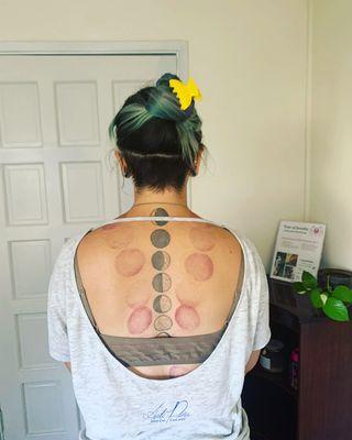 Modern cupping therapy to increase circulation and decrease inflammation.