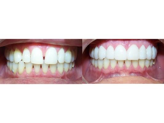 Before and after Lumineers "no preparation or anesthetic needed!"