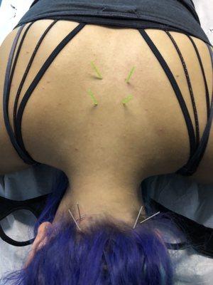 First time dry needling!