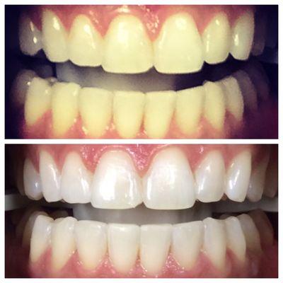 1 Hour in house Zoom Whitening.