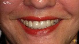 After Veneers